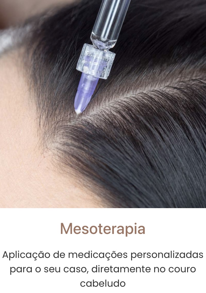mesoterapia capiar