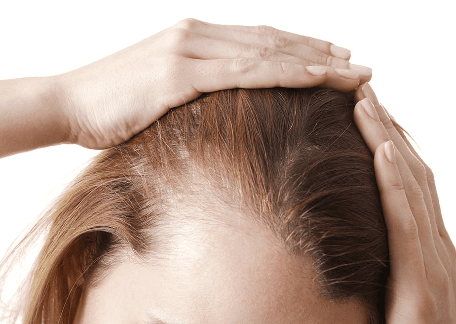 mulher com eflúvio telógeno