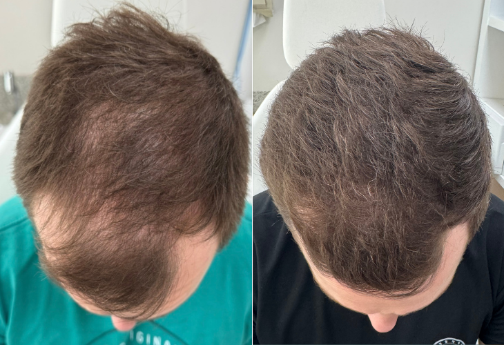 calvicie-masculina-1