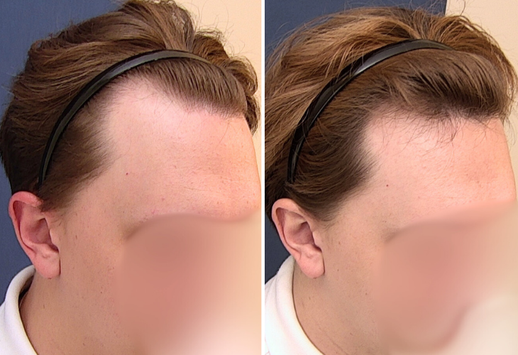 entradas-calvicie-homem