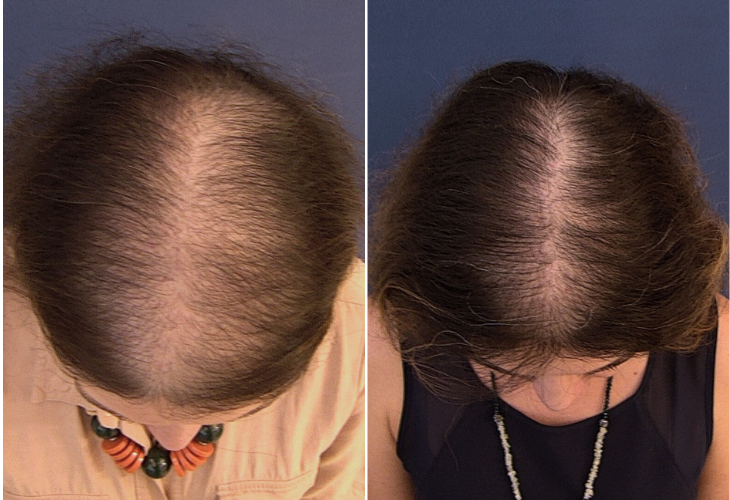 calvicie-feminina-avancada-1