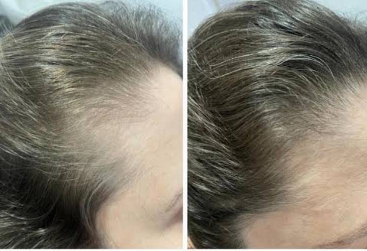 efluvio-telogeno-mulher