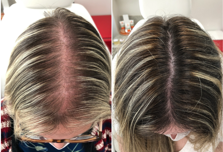 queda-capilar-mulher