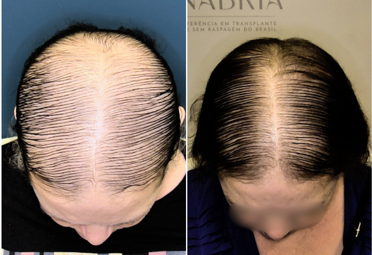 calvicie-feminina-avancada