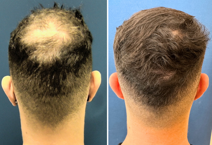 calvicie-masculina-vertex