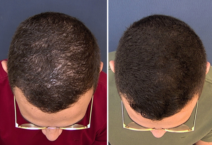 calvicie-masculina-homem